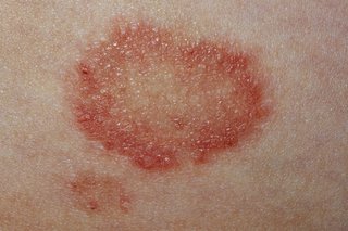 A circular red ringworm rash on a patch of skin