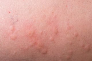 Urticaria raised bumps on skin