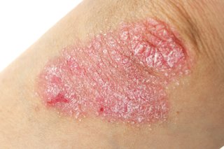 Elbow with a flaky red patch of psoriasis on the skin