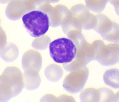 lymphoma