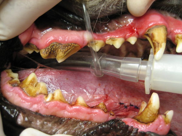 Зубной камень — одна из самых распространенных причин формирования гингивита