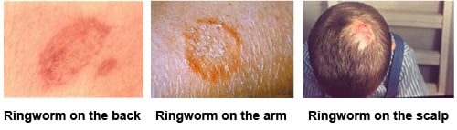 Composite image. First image has ringworm on the back. Second image has ringworm on the arm. Third image has ringworm on the scalp